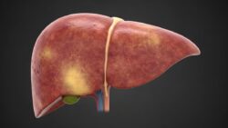 Hígado graso y café: efectos del consumo diario sobre riesgo de fibrosis hepática en adultos